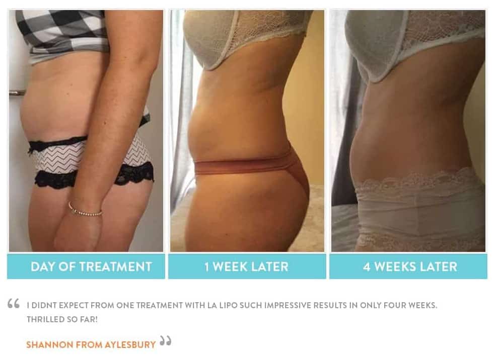before, Cryolipolysis Lymington