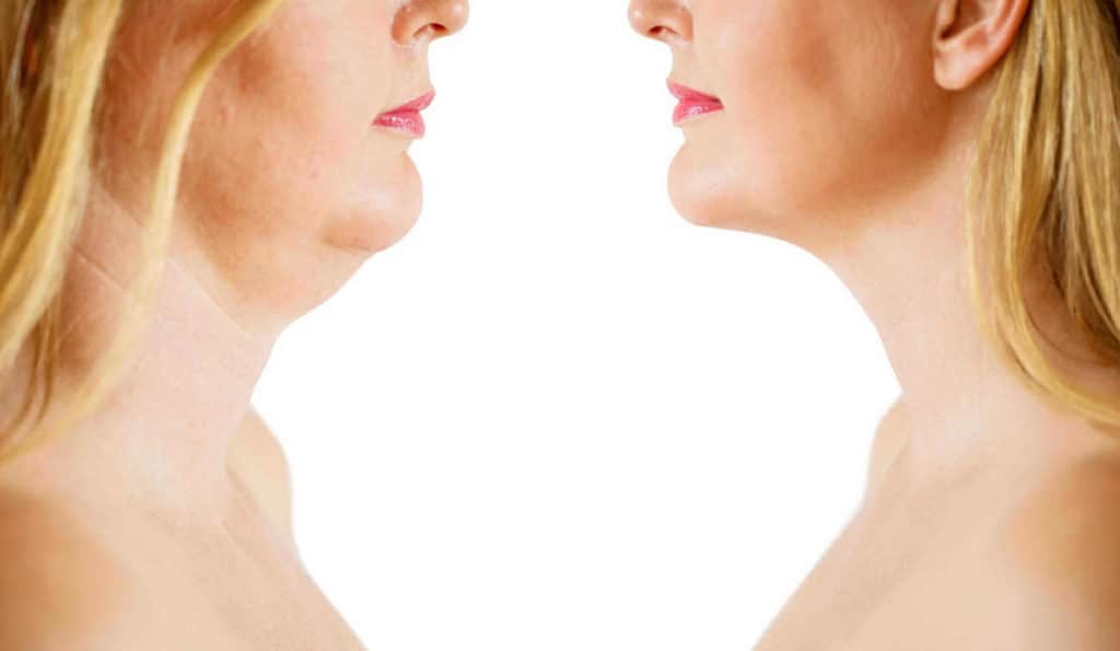 Double Chin treatment Lymington before and after results