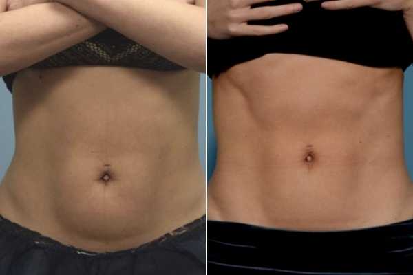 body sculpting FAQs Lymington