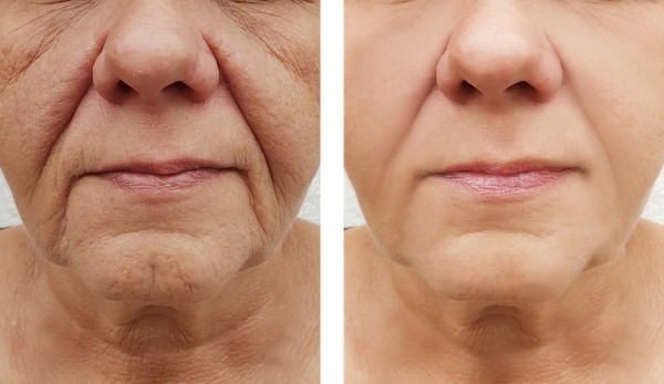 Learn more about Morpheus8 Treatment Lymington today!