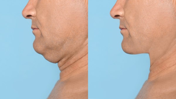 Which Non-Surgical Treatments Work Best for Jowls and Loose Skin Lymington?