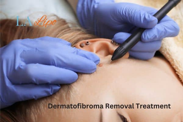 Dermatofibroma Removal Treatment Lymington