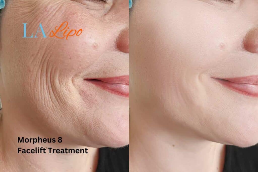 Morpheus8 Treatment Lymington for flawless skin! Call us today!