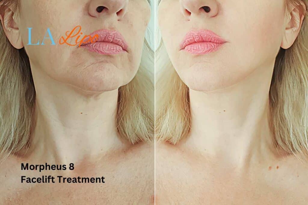 Turn back time with Morpheus8 Treatment Lymington