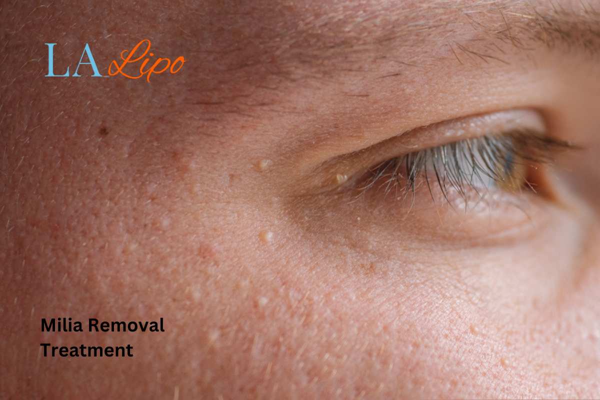 Cryopen Milia Removal: Is It the Easiest and Safest Option Lymington?
