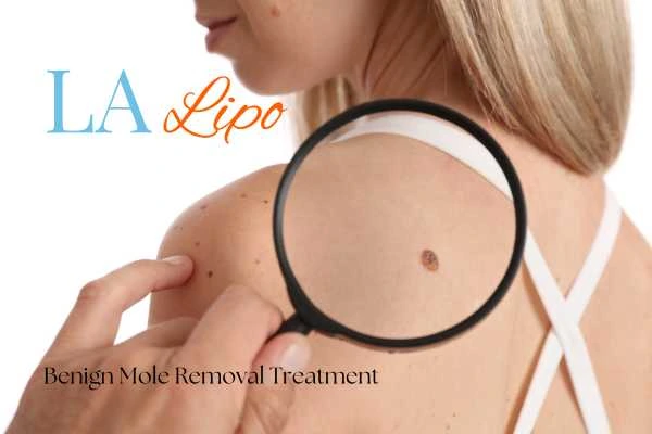 Woman having her inspection of blemish before mole removal Lymington