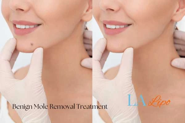 Before and after mole removal Lymington treatment