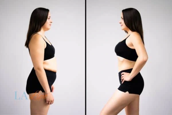 image of woman before and after results of LA-EMS Body Sculpting Lymington to help treat Diastasis recti