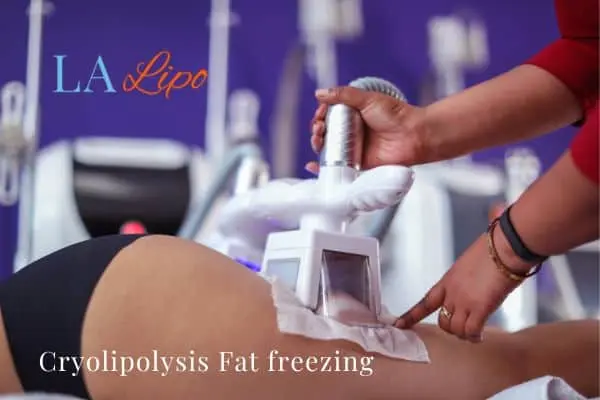 women getting fat freezing Lymington