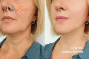 hi-fu for wrinkles Lymington before and after results