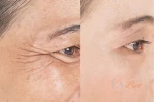 Before and after results of woman - HI-fu wrinkles reduction treatment Lymington