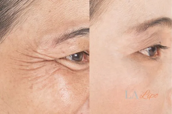 Before and after results of woman - HI-fu wrinkles reduction treatment Lymington