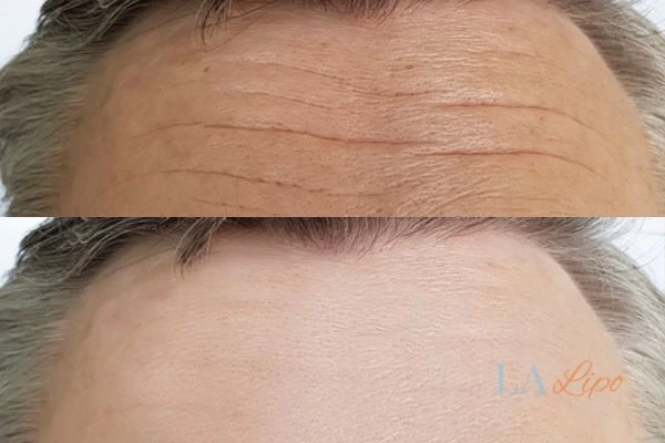 results of HIFU Lymington on mans forehead to help reduce lines and wrinkles
