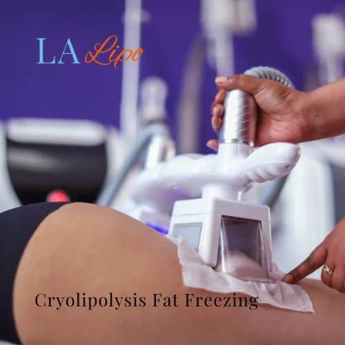 fat freezing - Cryolipolysis Lymington