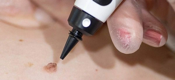 skin tag removal using cryopen Lymington