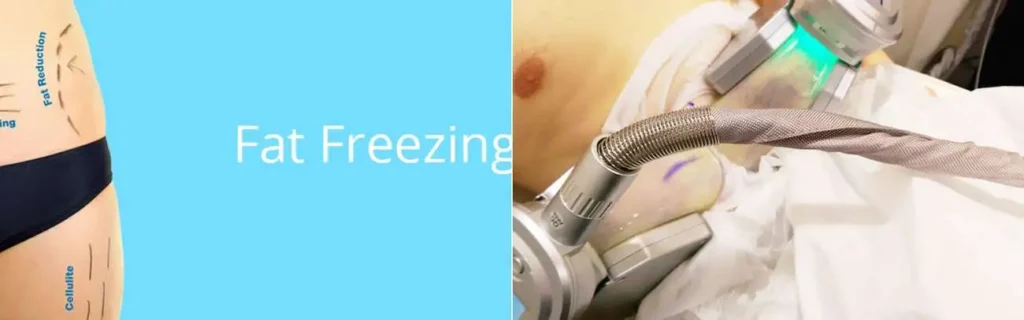 Fat freezing Lymington on multiple areas of the body