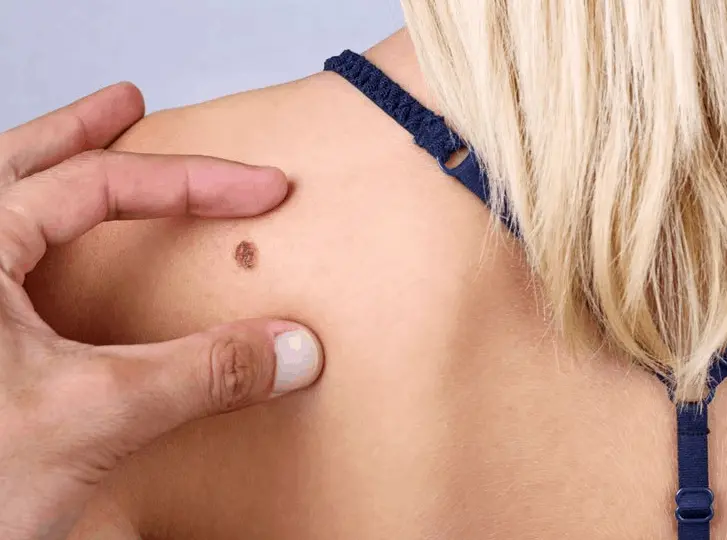 woman having mole removal Lymington consultation before treatment.