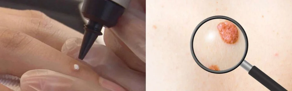Person getting moles removed with cryopen Lymington