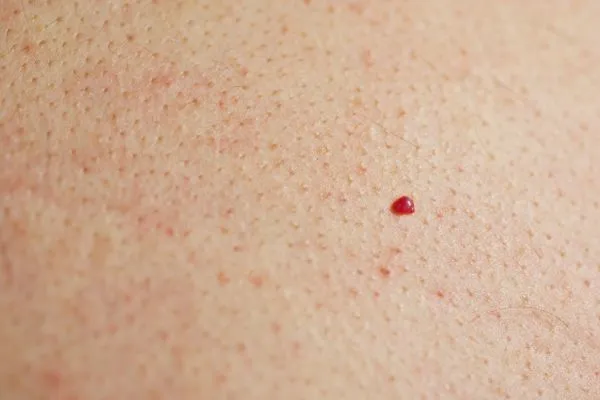 close up of a cherry angioma Lymington