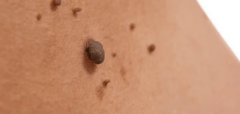 image of a skin tag Lymington