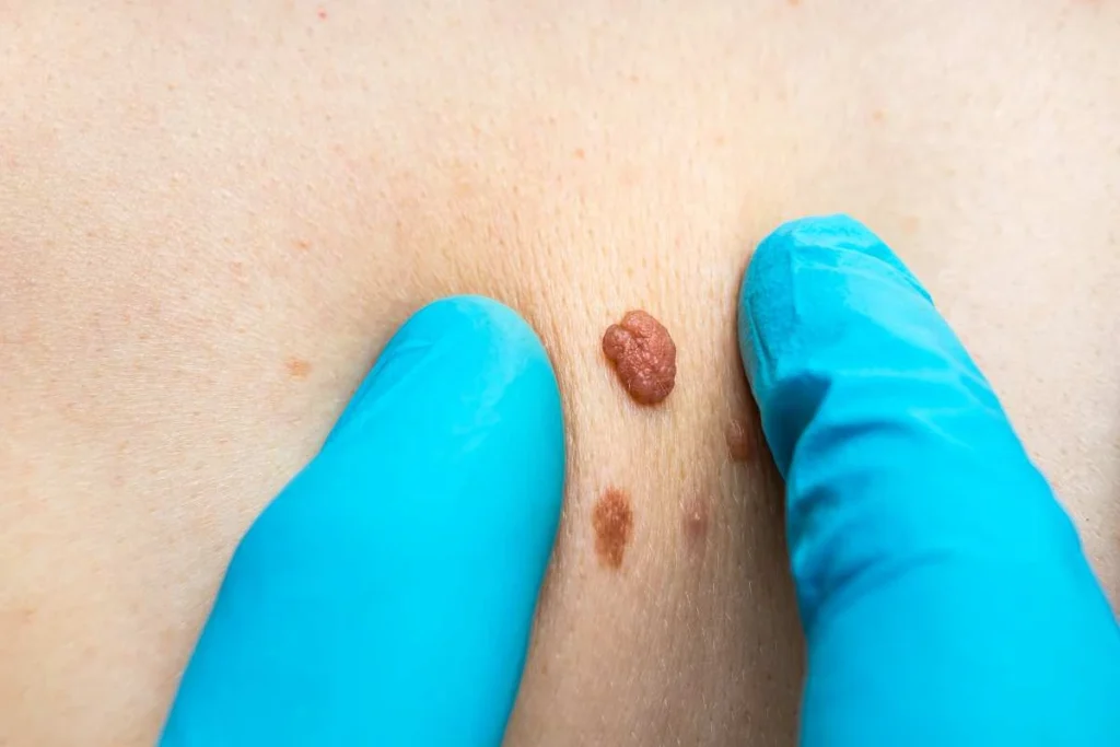 Consultant examining a skin tag Lymington