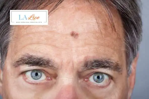 Solar Lentigo Removal Lymington image of man with mark on his forehead