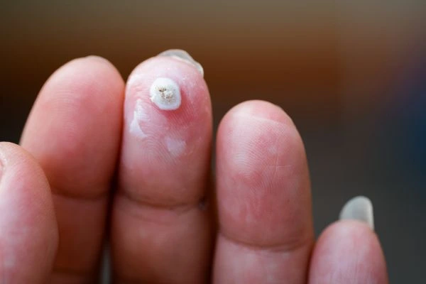 wart on person finger - cryotherapy to treat from LA LIPO Lymington