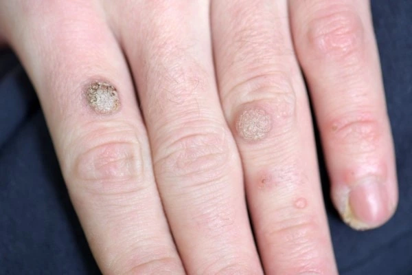 photo of warts on person hand - see wart removal Lymington from LA LIPO