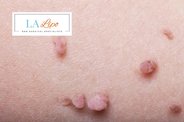 Does cryopen skin tag removal Lymington hurt? Find out now call our team today!