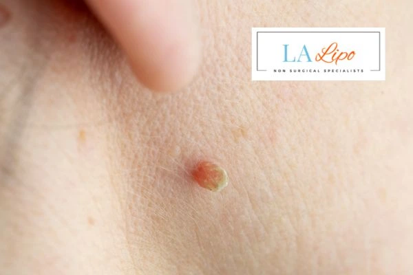 Book skin tag removal Lymington today speak to our team now!