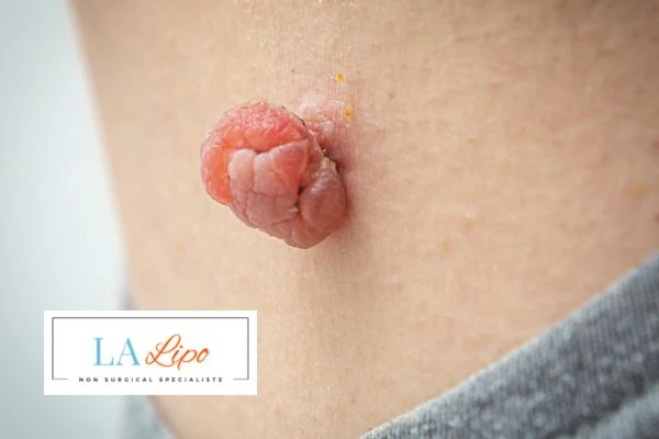 Interested in skin tag removal Lymington? Concerned about the pain? Find out more today!