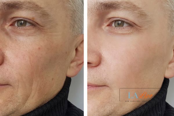 See the amazing results of Morpheus8 Treatment Lymington!