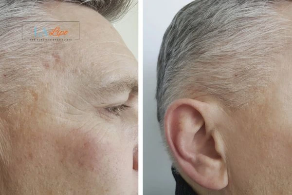 Mens Before & After Morpheus 8 Results Lymington