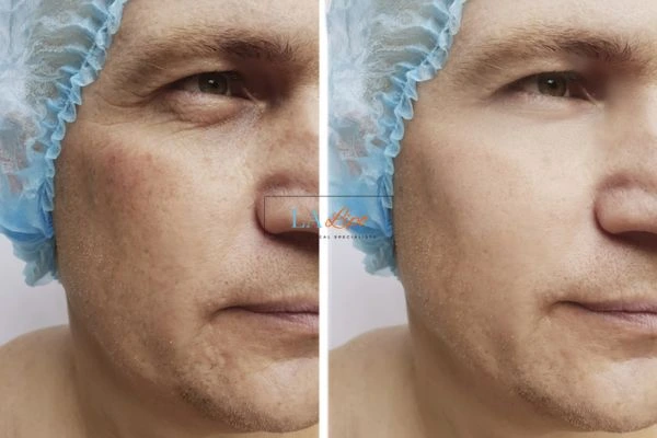 Before and after Morpheus 8 Results Lymington