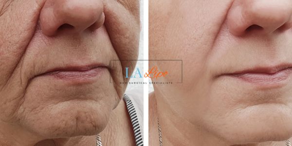 Older lady deeper wrinkle reduction - LA LIPO Morpheus 8 Results Lymington