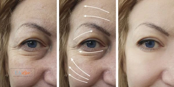 Amazing eye lift Morpheus 8 results Lymington