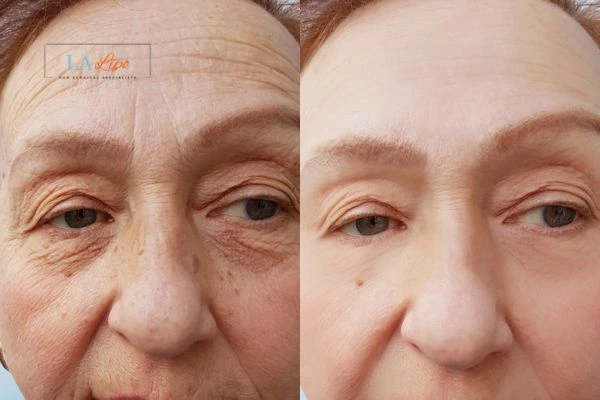 The powerful benefits of Morpheus8 Treatment Lymington - Call Our team today!