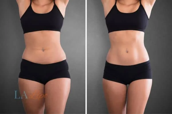before and after results of non-surgical treatment to help a woman's body image and mental health Lymington