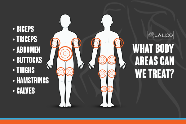 Diagram to show areas you can have LA-EMS Body Sculpting Treatment Lymington