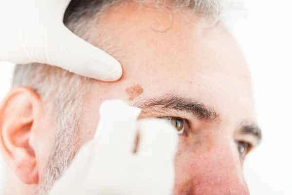 Age spots and elderly people Lymington what is the link?