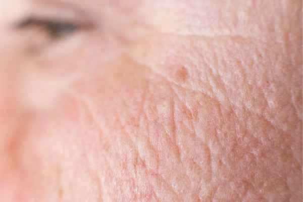 close up picture of a woman's face showing an age spot Lymington