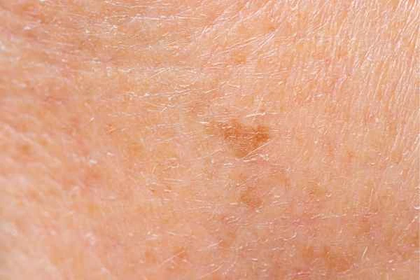 close up picture of age spots Lymington