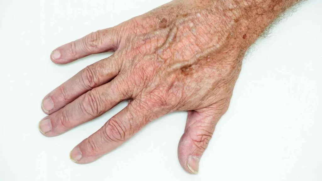 Male hand showing age spot Lymington