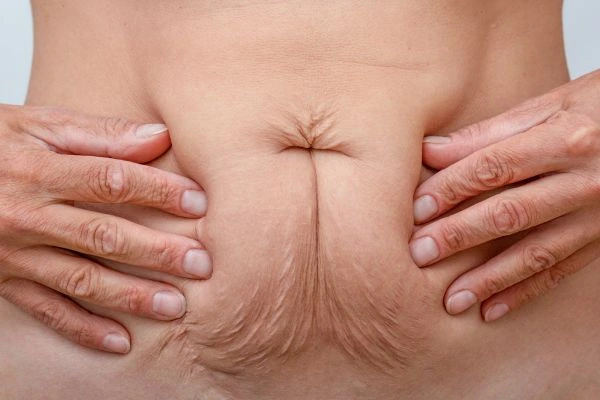 Image of a woman's stomach with loose skin - example of skin tightening Lymington options
