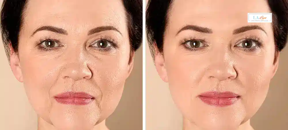 How Long Does It Take to See Results and How Long Do They Last Lymington?
