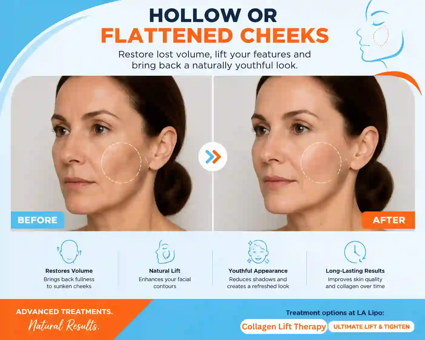 Sign #4: Hollow or Flattened Cheeks Lymington